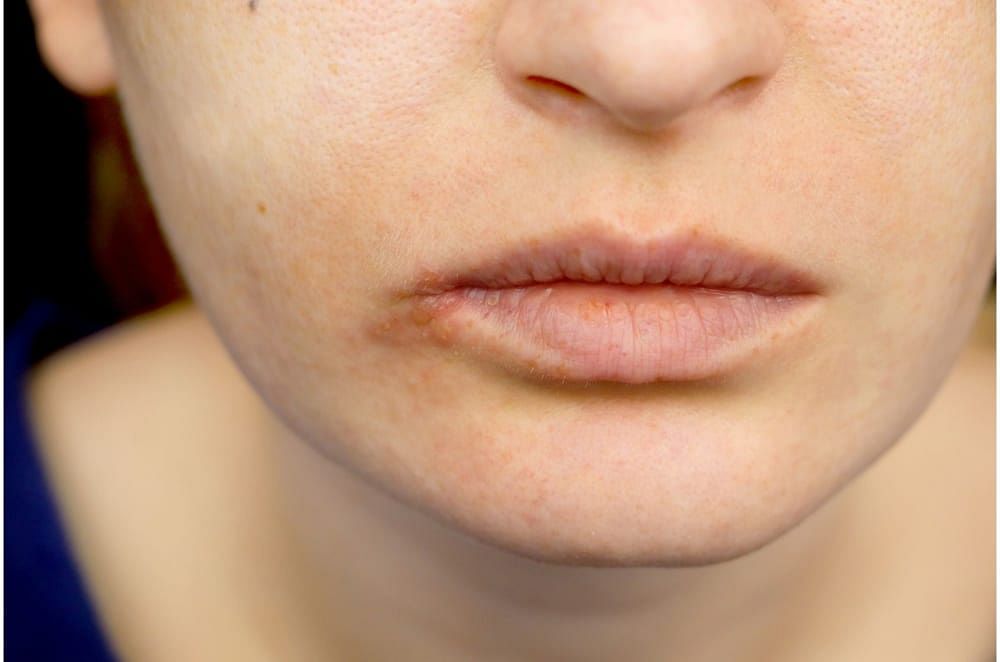 Pigmented Lips Causes, Treatment & More